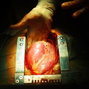 Organ Harvesting Facts