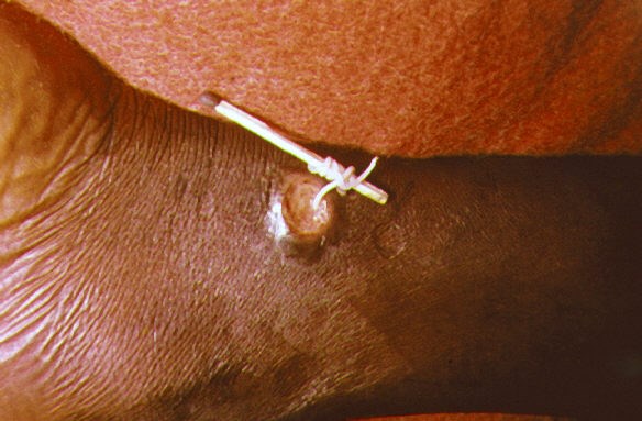 Interesting Guinea Worm Fact