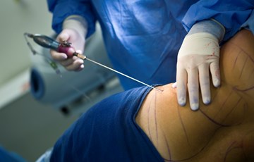 Interesting Liposuction Fact