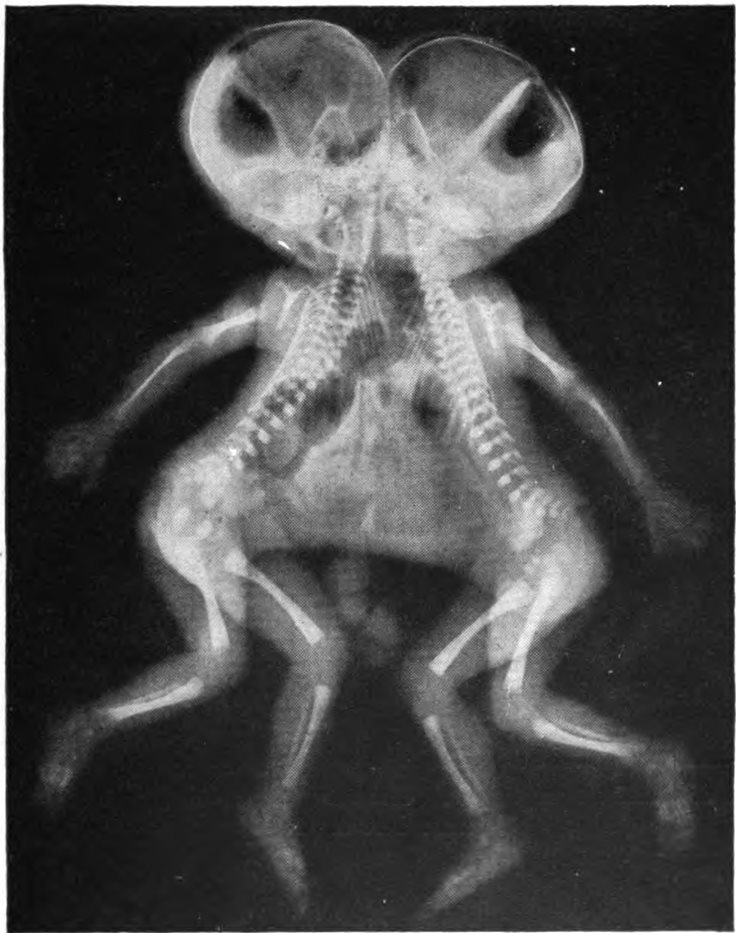 Conjoined Twins Facts